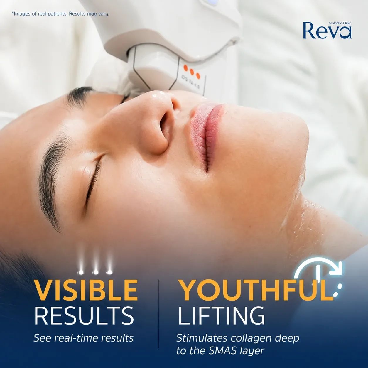 Ultherapy Program for skin lifting and collagen stimulation.