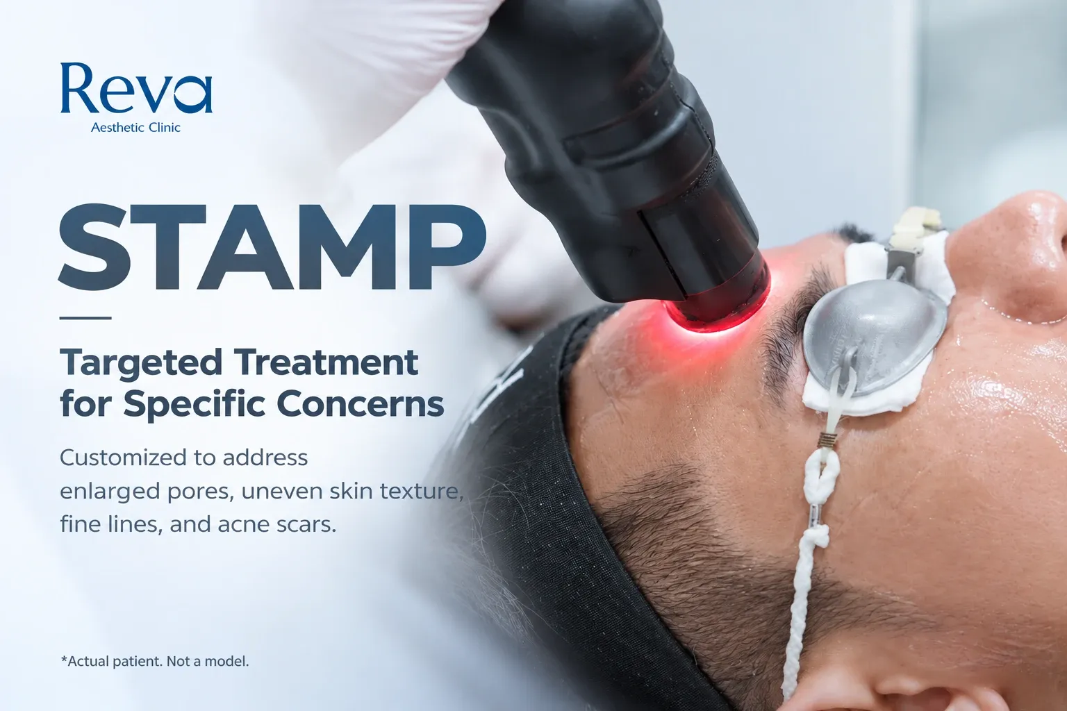 STAMP technique of Program RedTouch Pro at Reva Clinic for targeted treatment of enlarged pores, uneven skin texture, fine lines, and acne scars