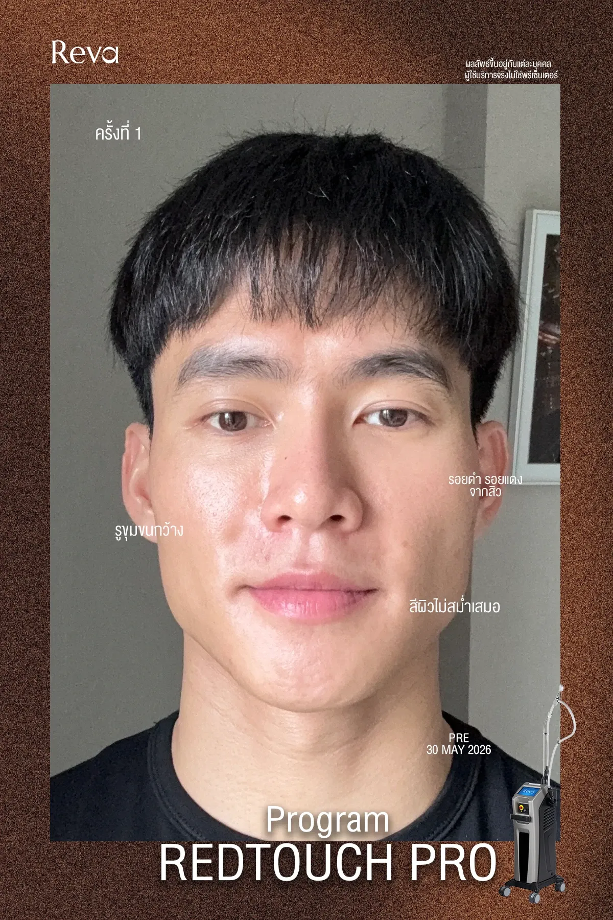 รีวิวหลังทำ red tocuh ครบ 1 เดือน