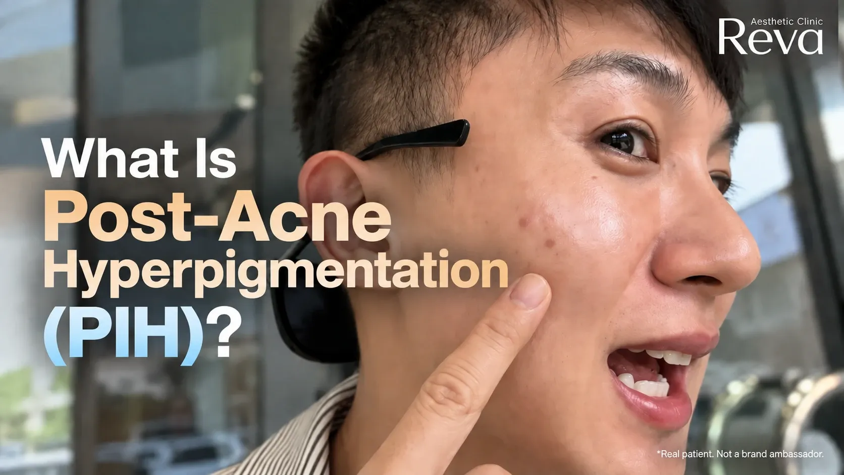 Post-Acne Hyperpigmentation
