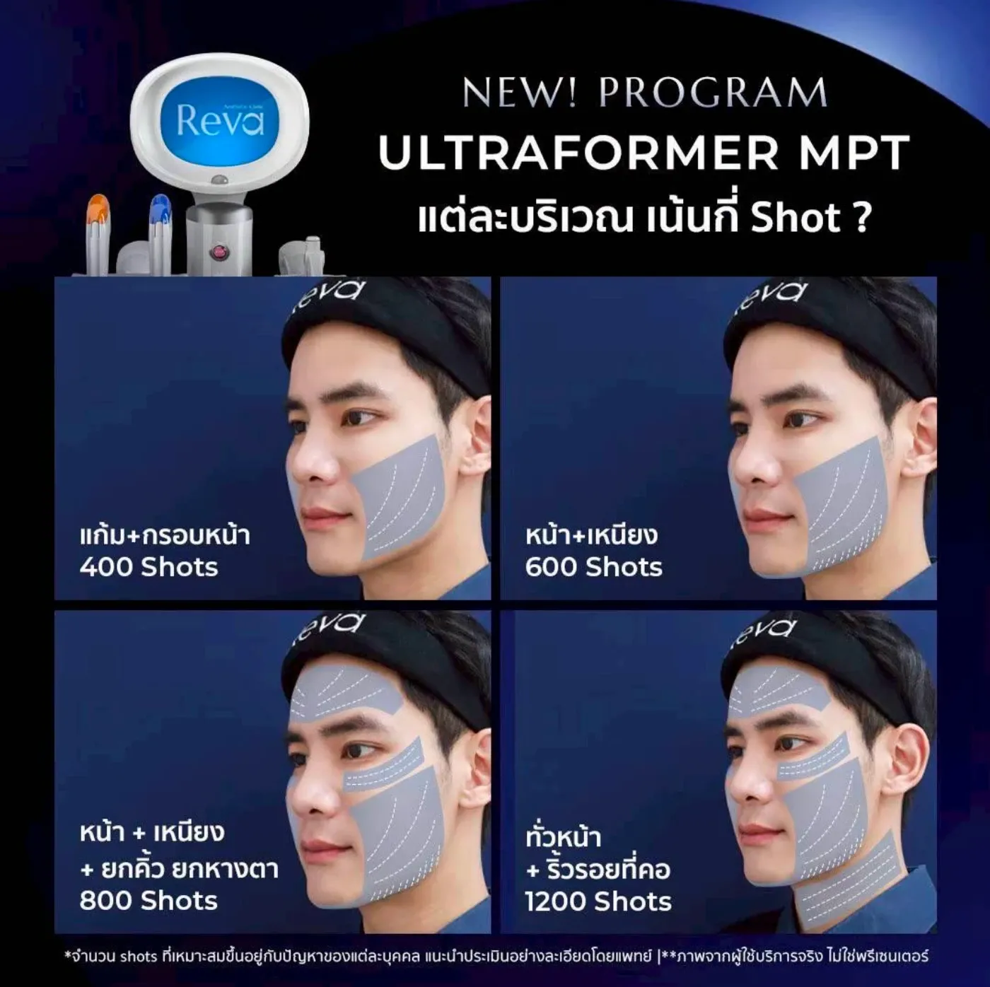 ตารางแนะนำจำนวน Shot ตามบริเวณใบหน้าและคอ โดยแพทย์ประเมินเป็นรายบุคคล