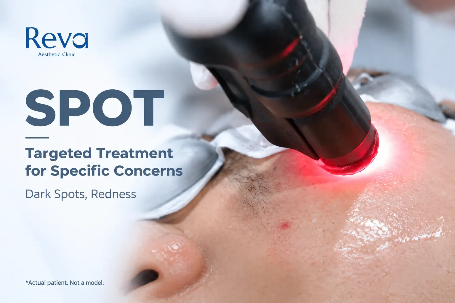 SPOT technique of Program RedTouch Pro at Reva Clinic for targeted treatment of dark spots and redness