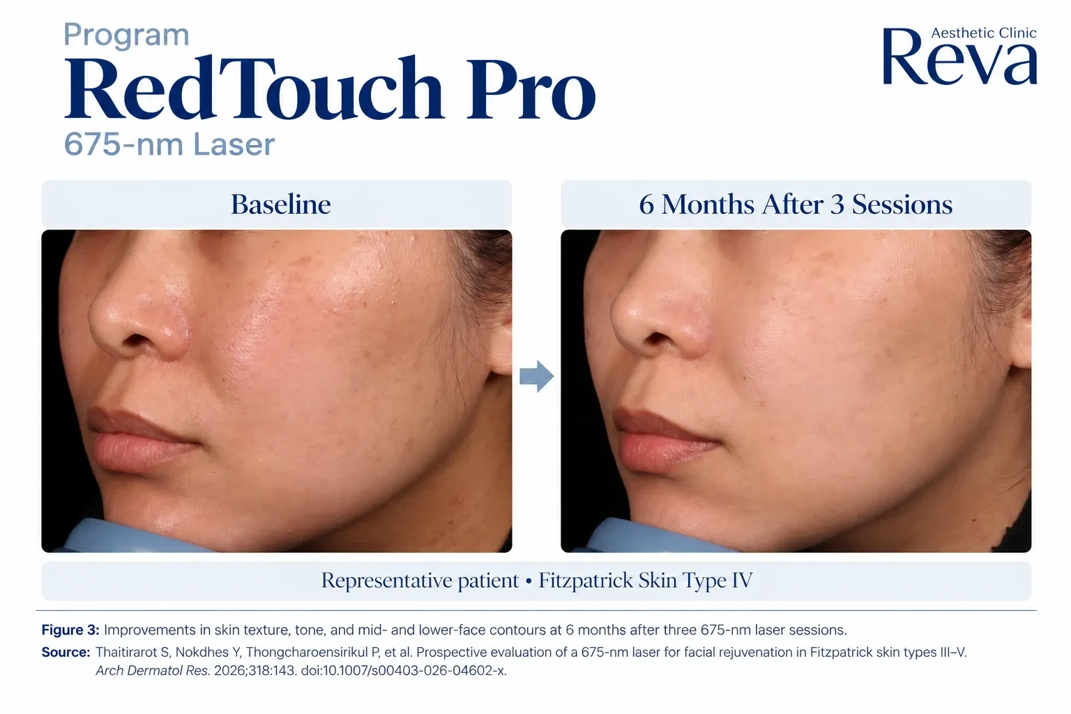 รีวิว Red touch pro  รักษาร่องข้างแก้ม