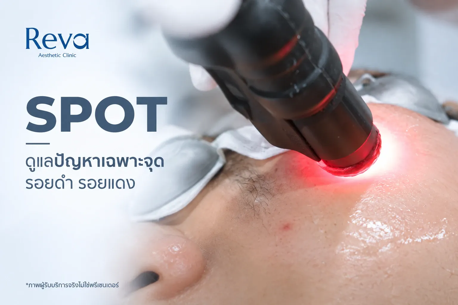 เทคนิค SPOT ของโปรแกรม RedTouch Pro ที่ Reva Clinic สำหรับดูแลปัญหาเฉพาะจุด รอยดำ และรอยแดง