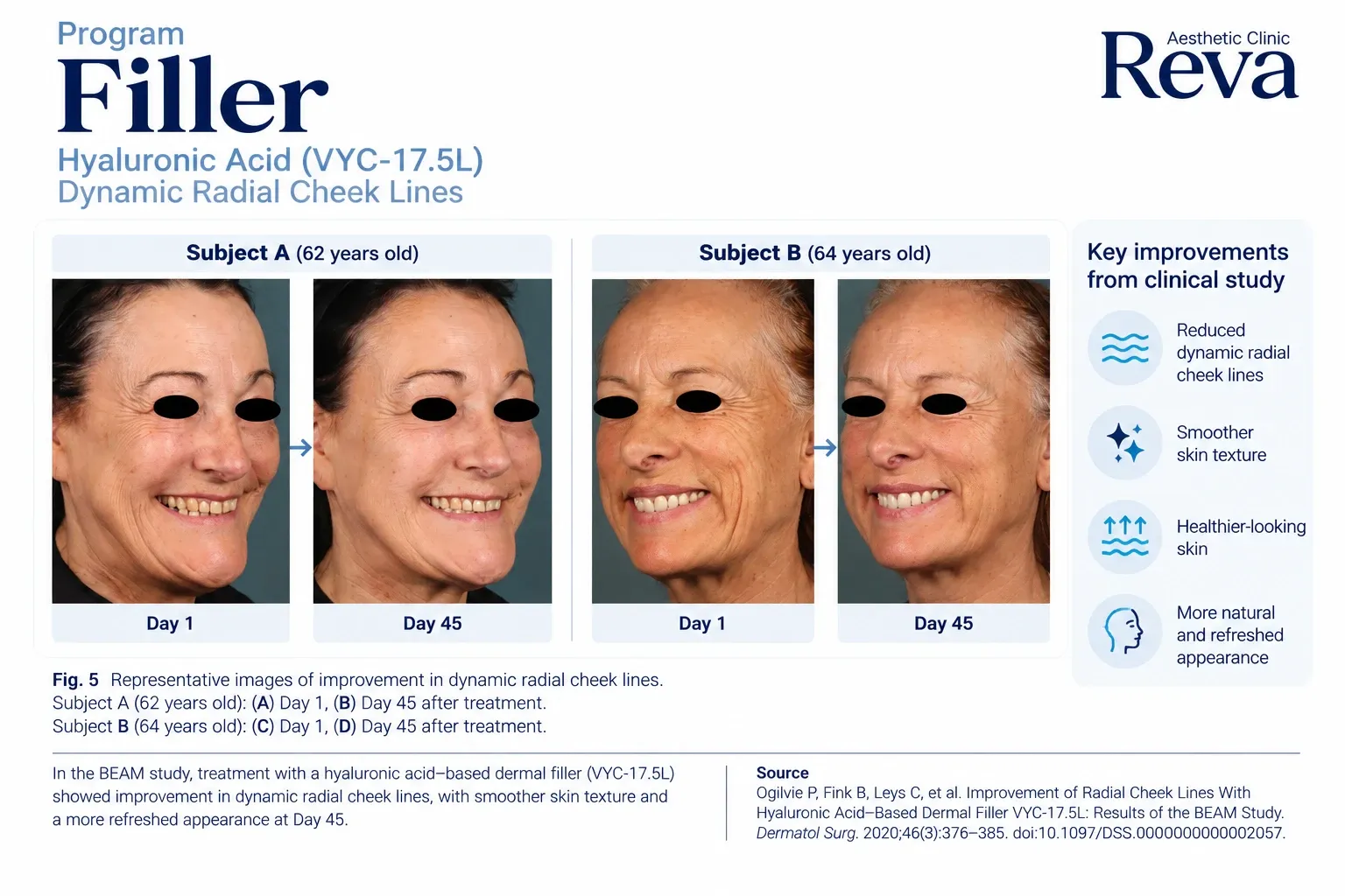 รีวิว Filler รักษาร่องข้างแก้ม