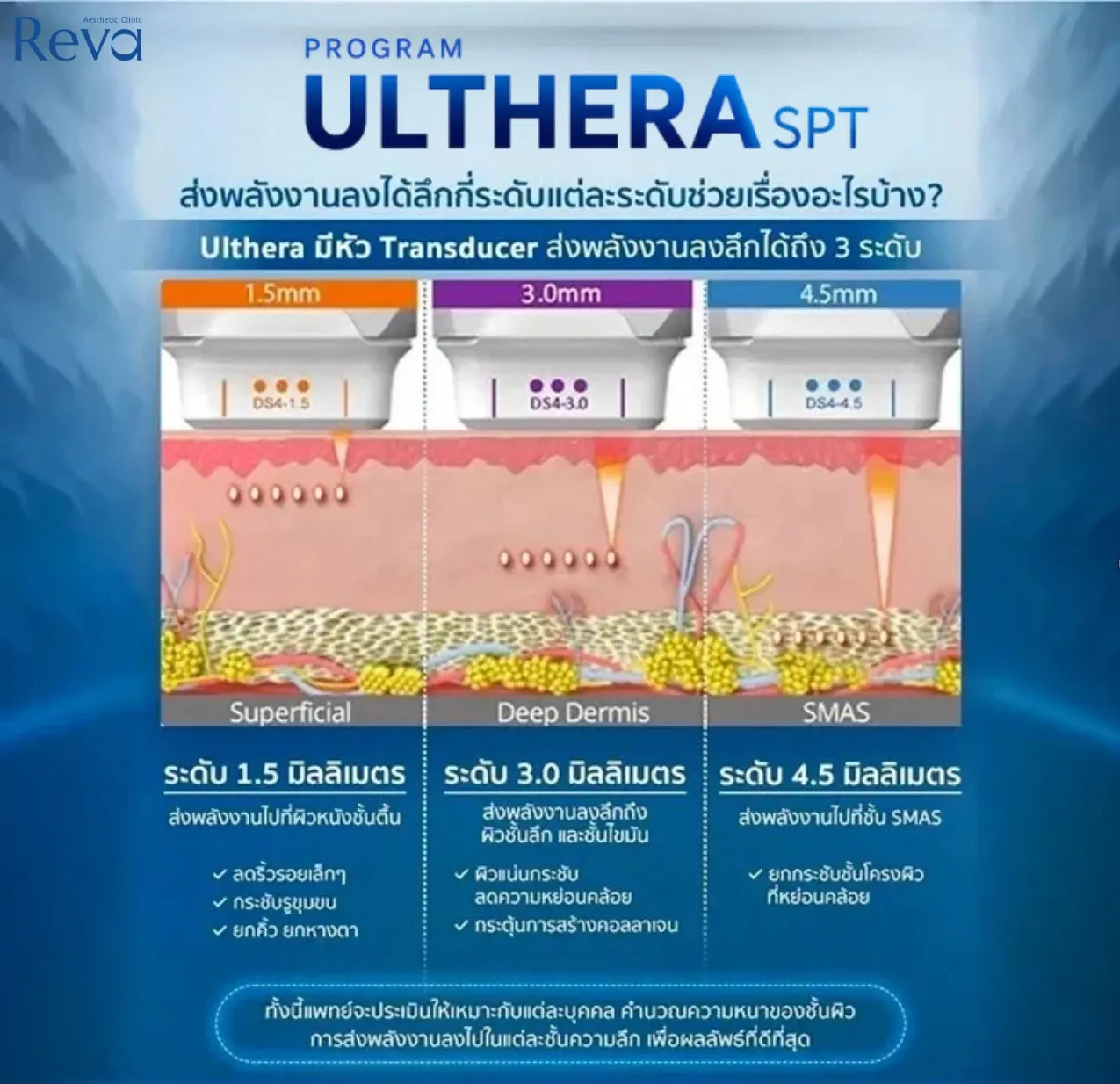 อินโฟกราฟิก Program Ulthera SPT แสดงหัว 1.5, 3.0 และ 4.5 มม. ลงชั้นผิว Superficial, Deep Dermis และ SMAS