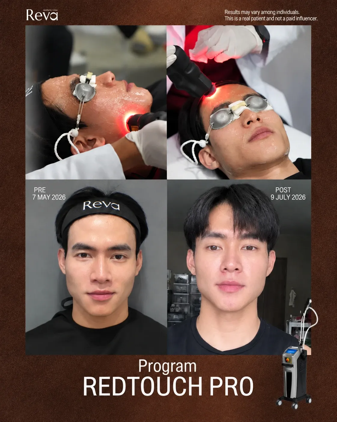 RedTouch Pro ช่วยเรื่องรูขุมขนกว้างได้ไหม