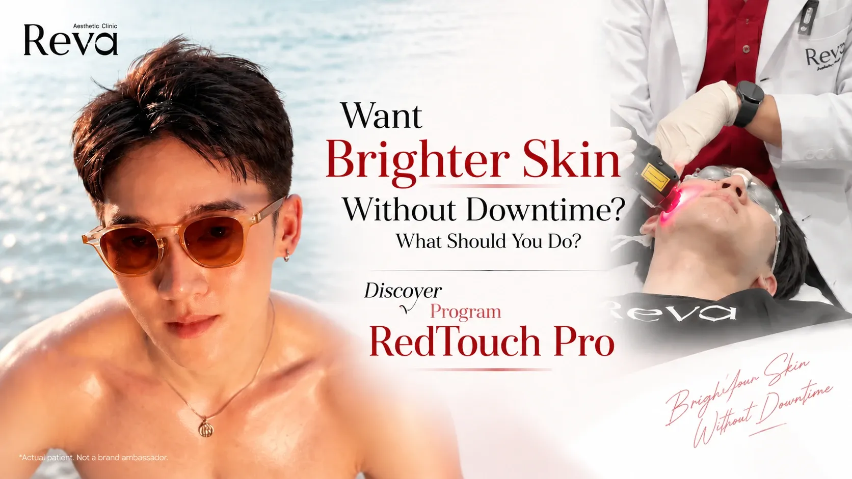 Bright skin without downtime with Program RedTouch Pro 675 nm laser at Reva Clinic