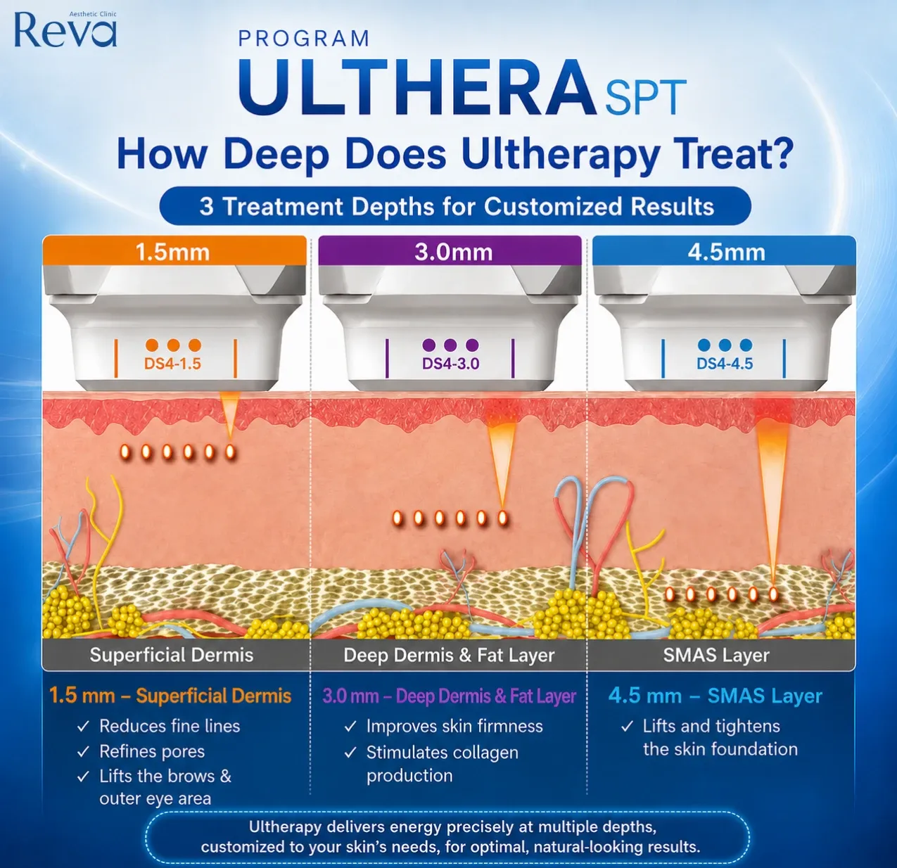 Infographic of Program Ulthera SPT showing 1.5, 3.0, and 4.5 mm transducers targeting superficial dermis, deep dermis, and SMAS