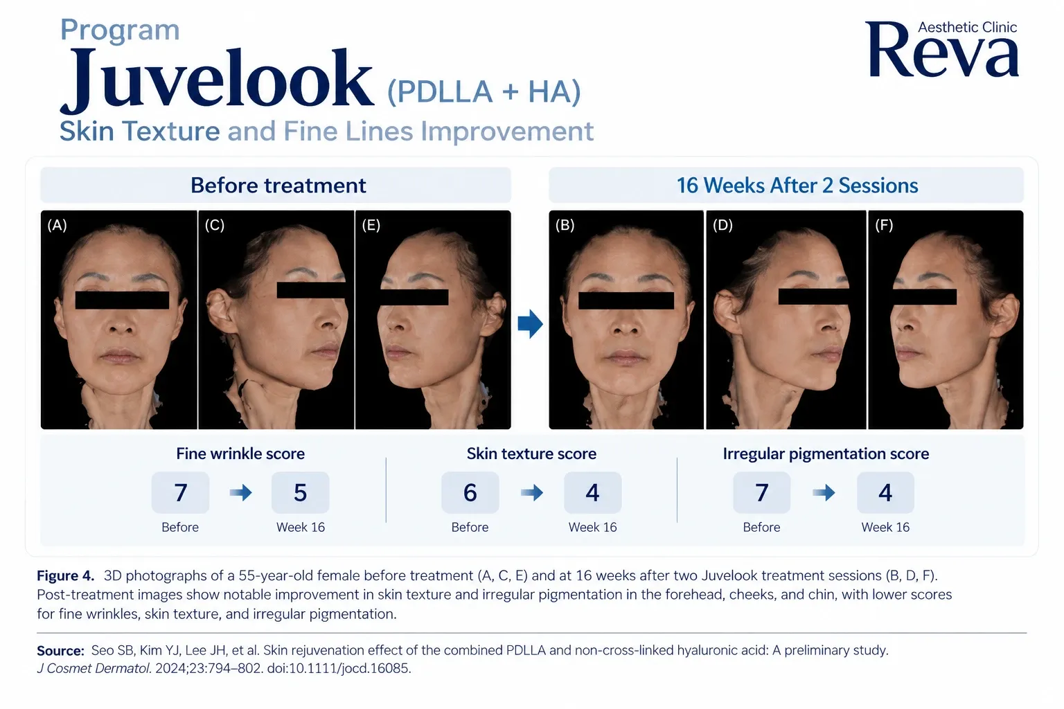รีวิว Juvelook รักษาร่องข้างแก้ม