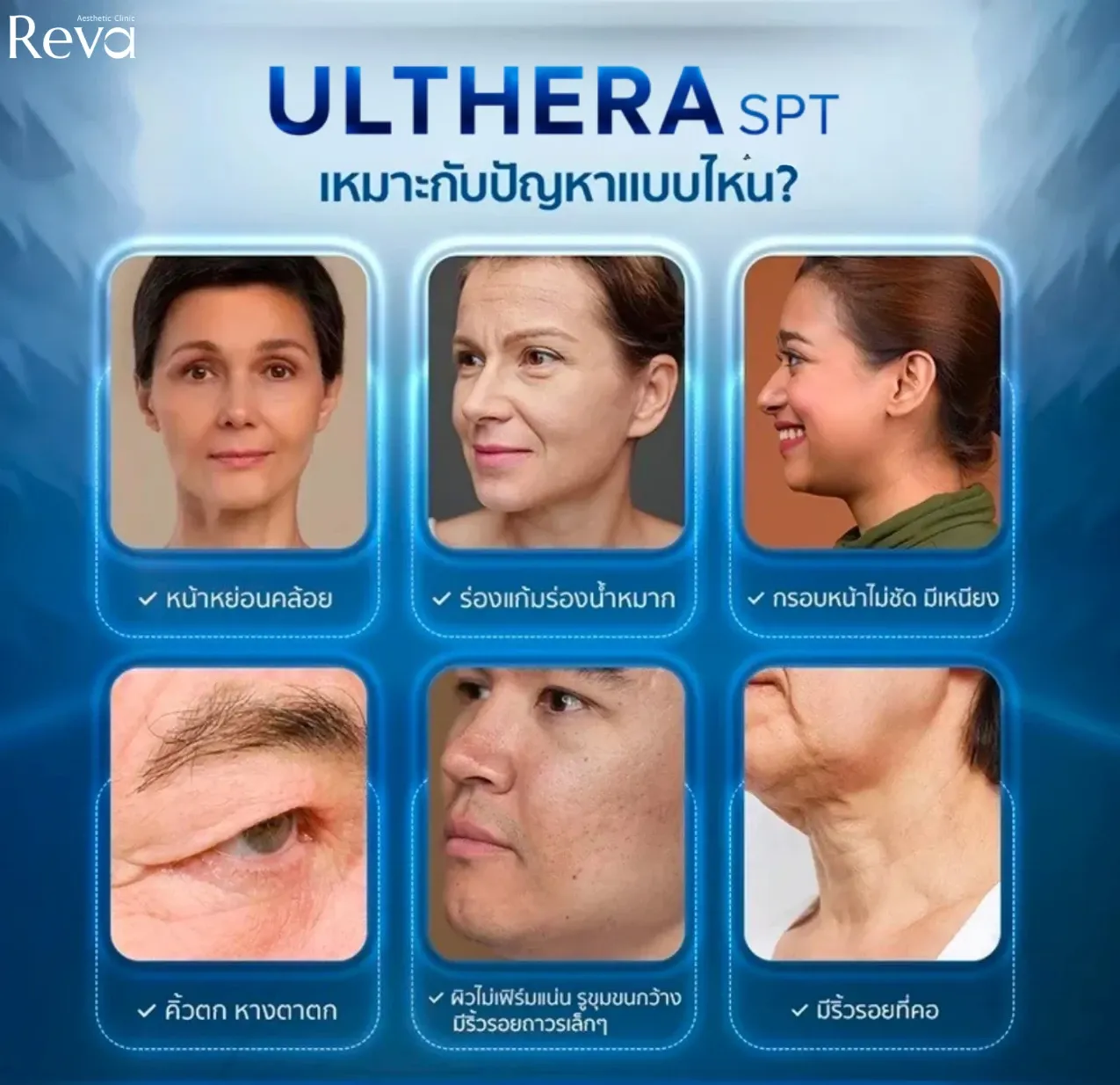 Program Ulthera SPT เหมาะกับผู้ที่มีปัญหาผิวหย่อนคล้อย กรอบหน้าไม่ชัด คิ้วตก และริ้วรอยบริเวณใบหน้าและลำคอ