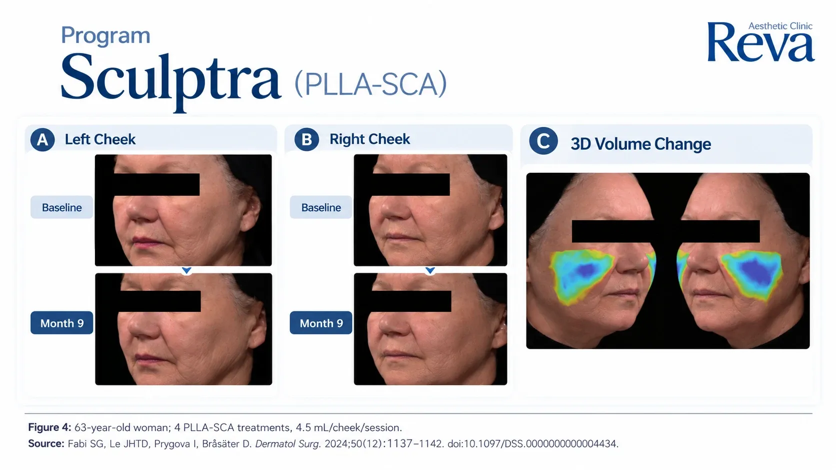 รีวิว Sculptra รักษาร่องข้างแก้ม