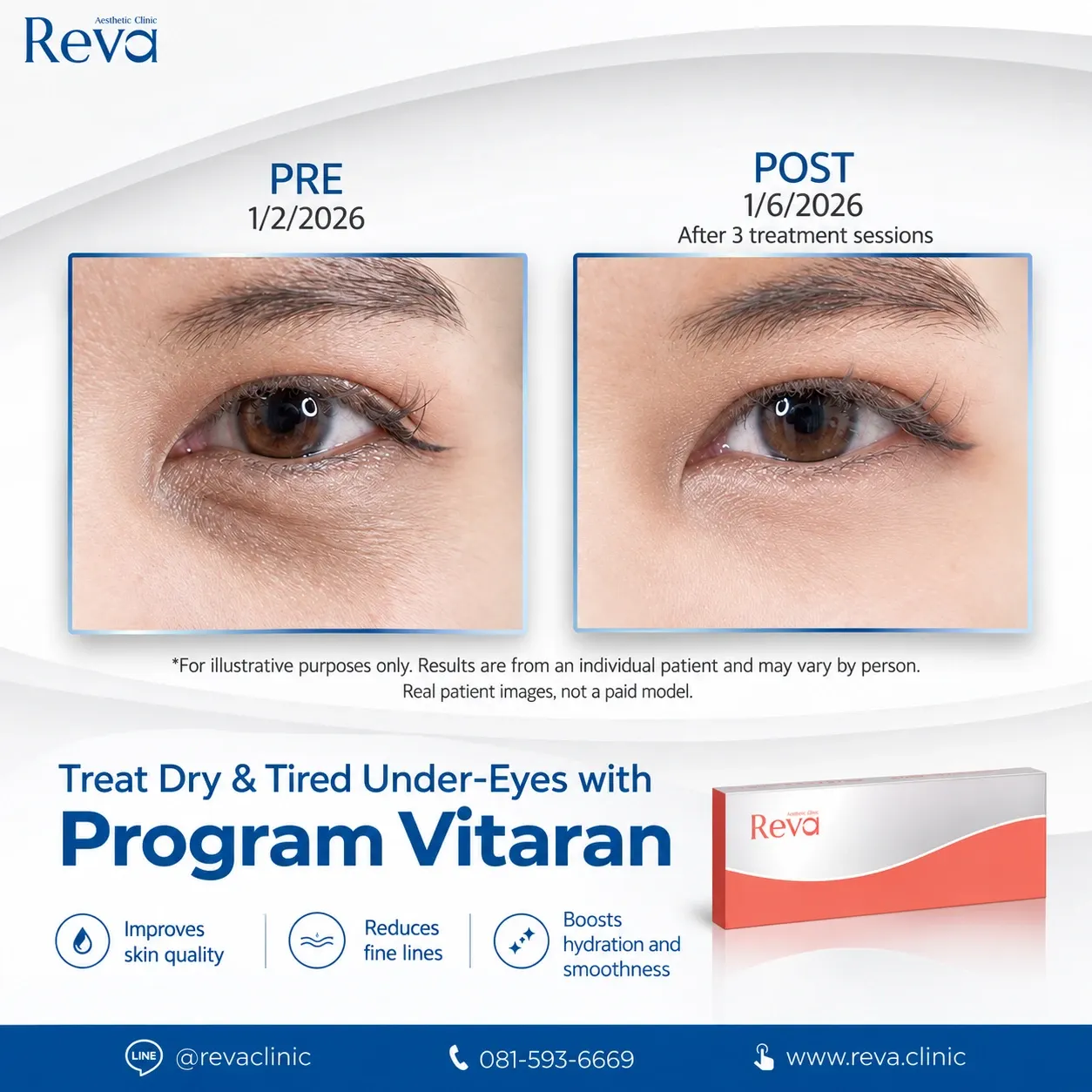 vitaran Improve Fine Lines Under the Eyes