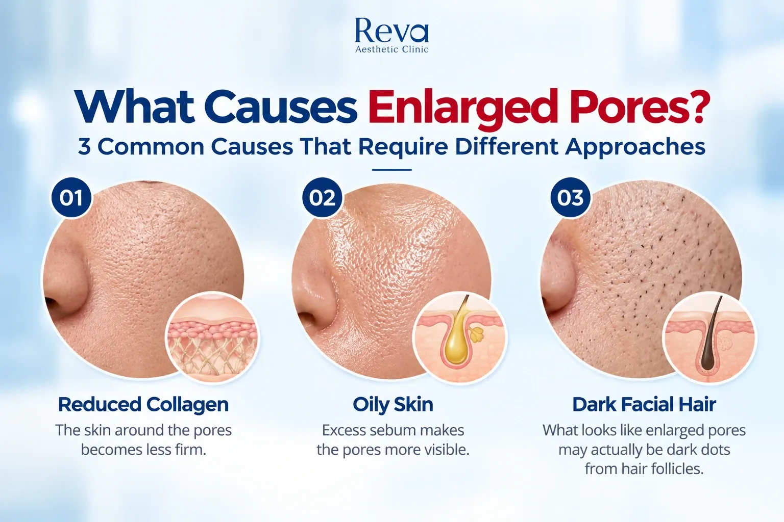 3 Common Causes of enlarge pores