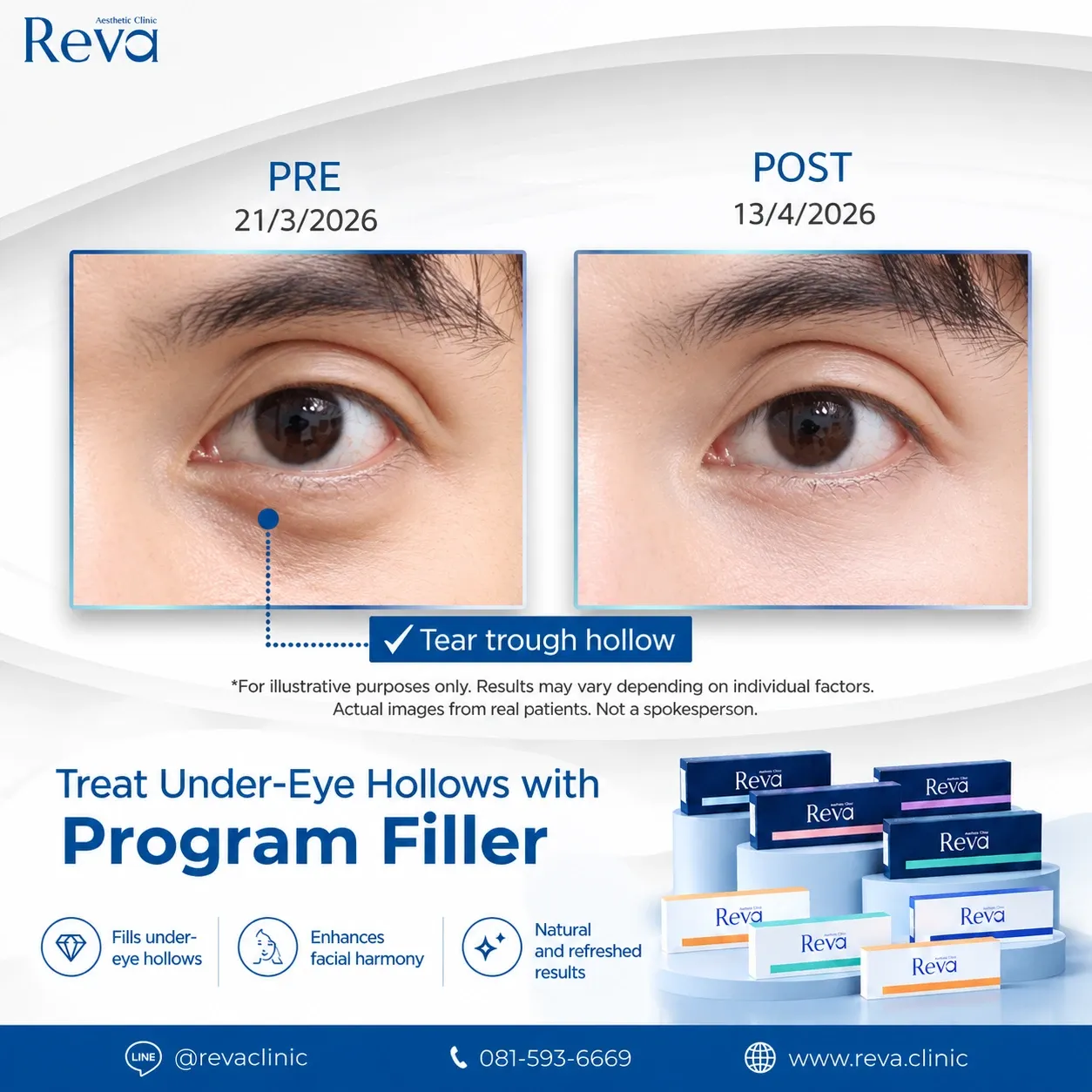 review under eye filler