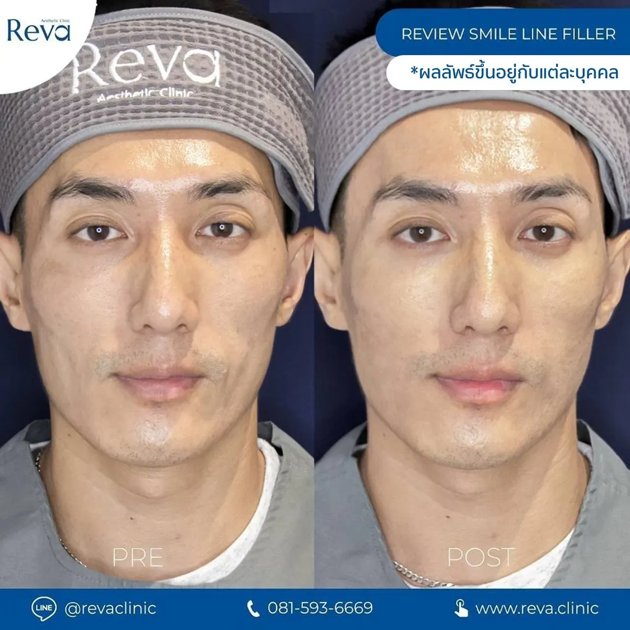 รีวิวรักษาร่องข้างแก้ม