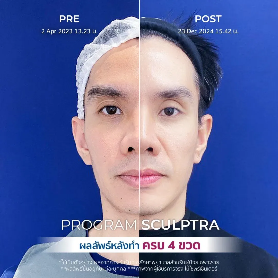 รีวิวรักษาร่องข้างแก้ม