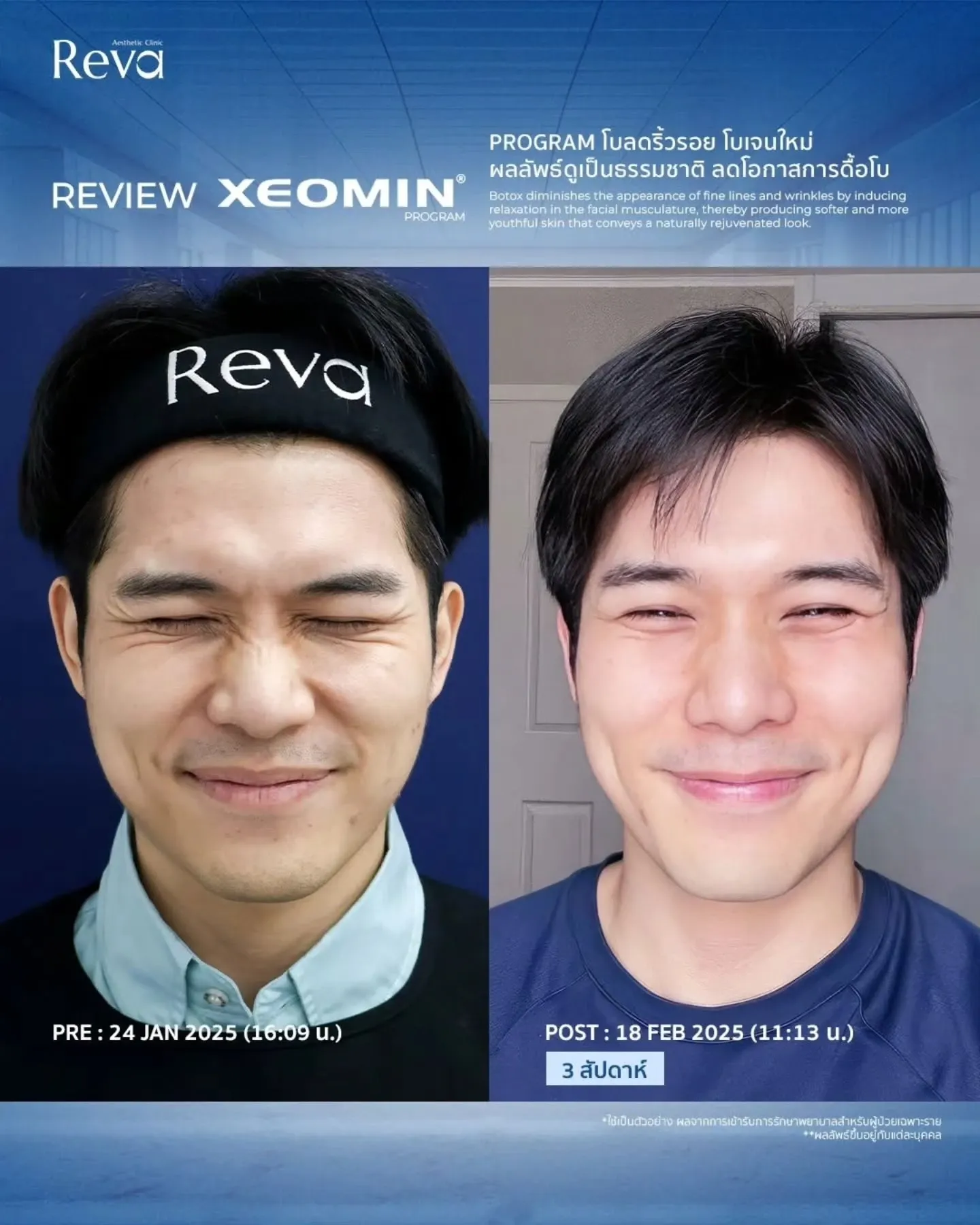 xeomin review