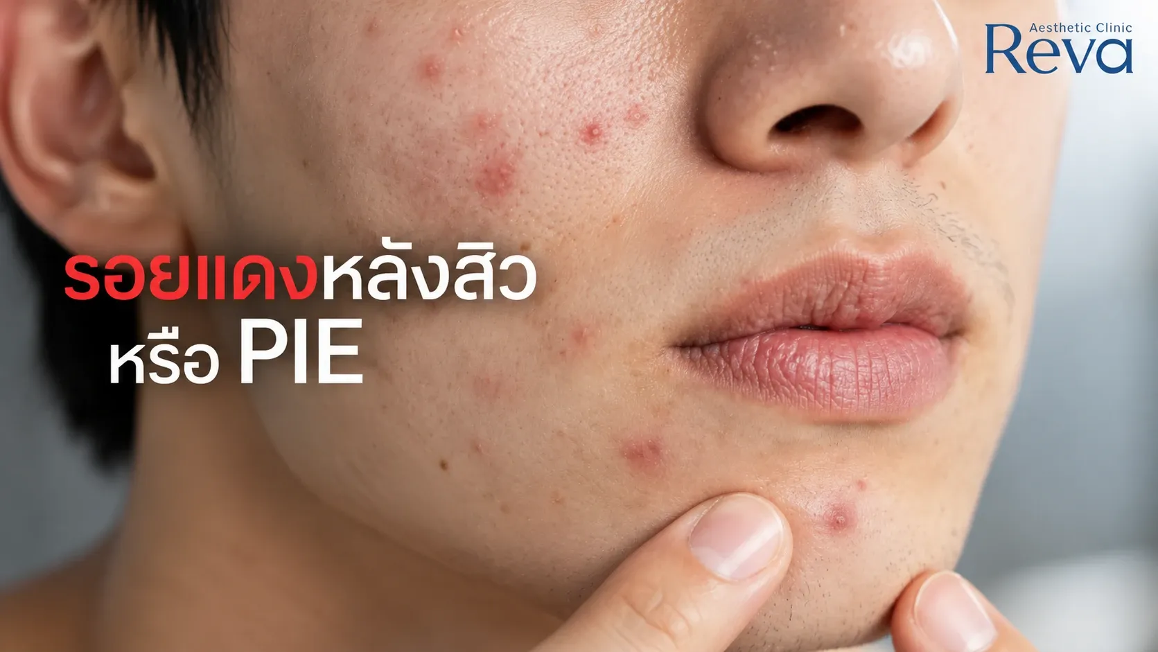 รอยแดงหลังสิว หรือ PIE