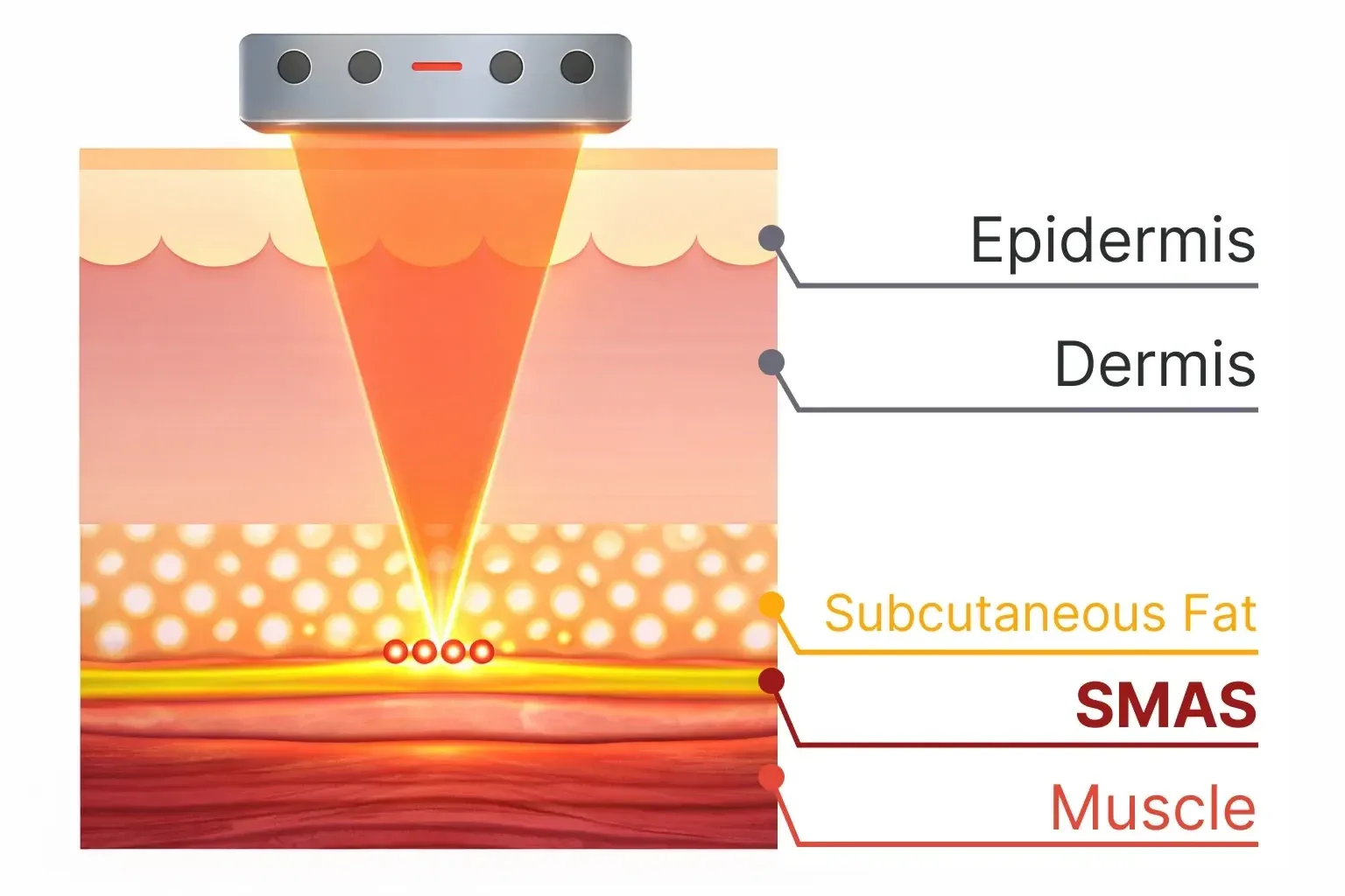 Skin cross-section showing a treatment head focusing energy into the SMAS layer beneath the epidermis and dermis