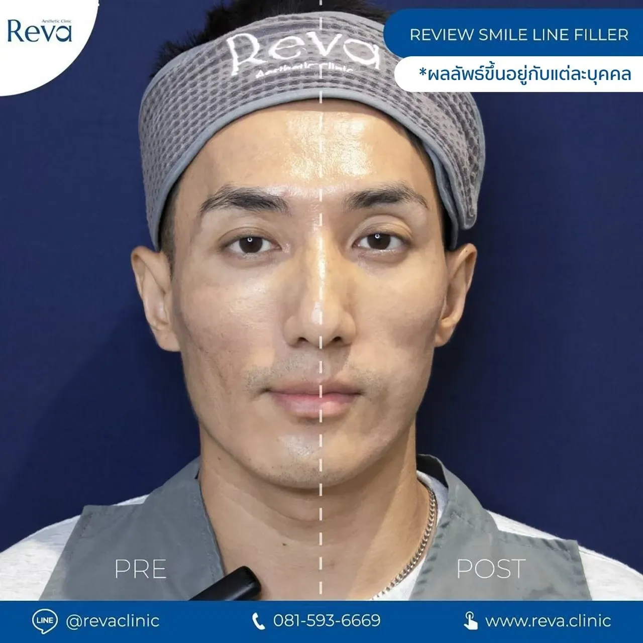 รีวิวรักษาร่องข้างแก้ม