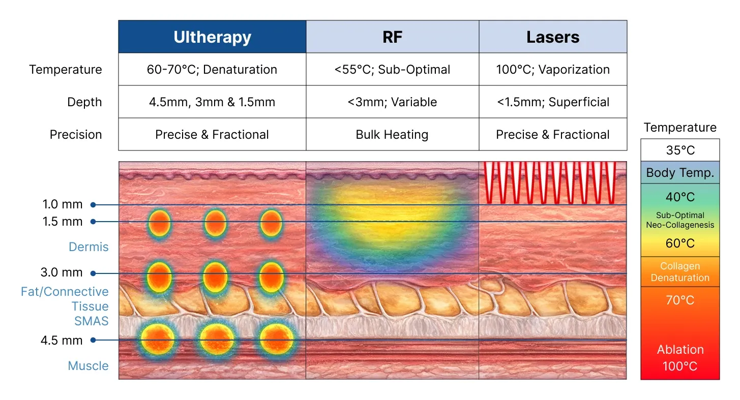 อินโฟกราฟิกเปรียบเทียบ Ultherapy, RF และเลเซอร์ ด้านอุณหภูมิ ความลึก และความแม่นยำ พร้อมพลังงานลงถึงชั้น SMAS