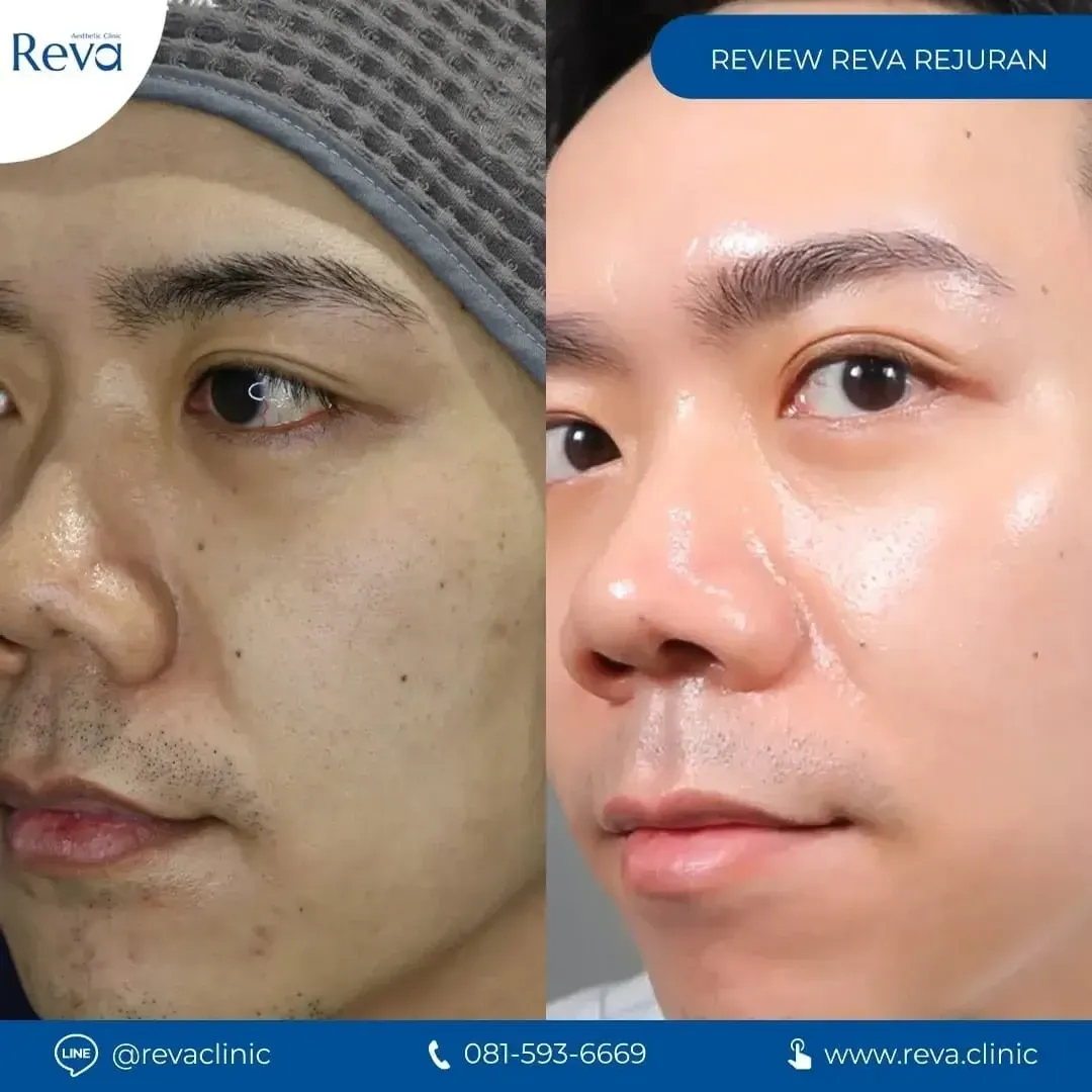 Before-and-after clinical photos showing smoother skin and reduced fine wrinkles after Polynucleotide (PN) treatment.