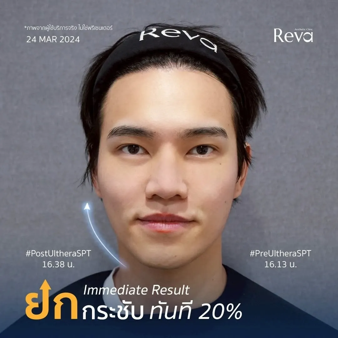 ภาพผลลัพธ์ผู้รับบริการจริงหลังทำ Program Ulthera SPT แสดงการเปลี่ยนแปลงของกรอบหน้าและความกระชับหลังทำ