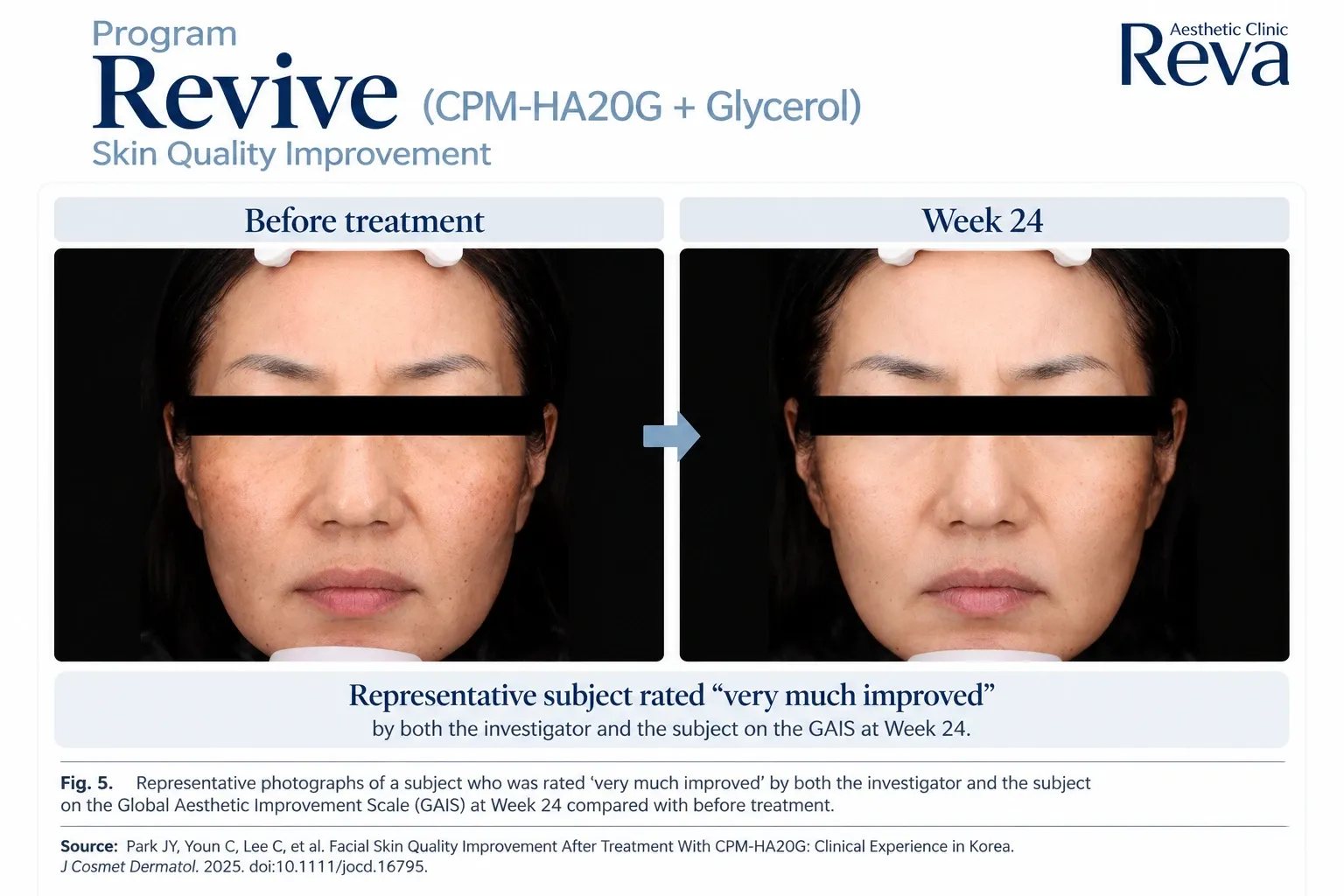รีวิว Revive รักษาร่องข้างแก้ม