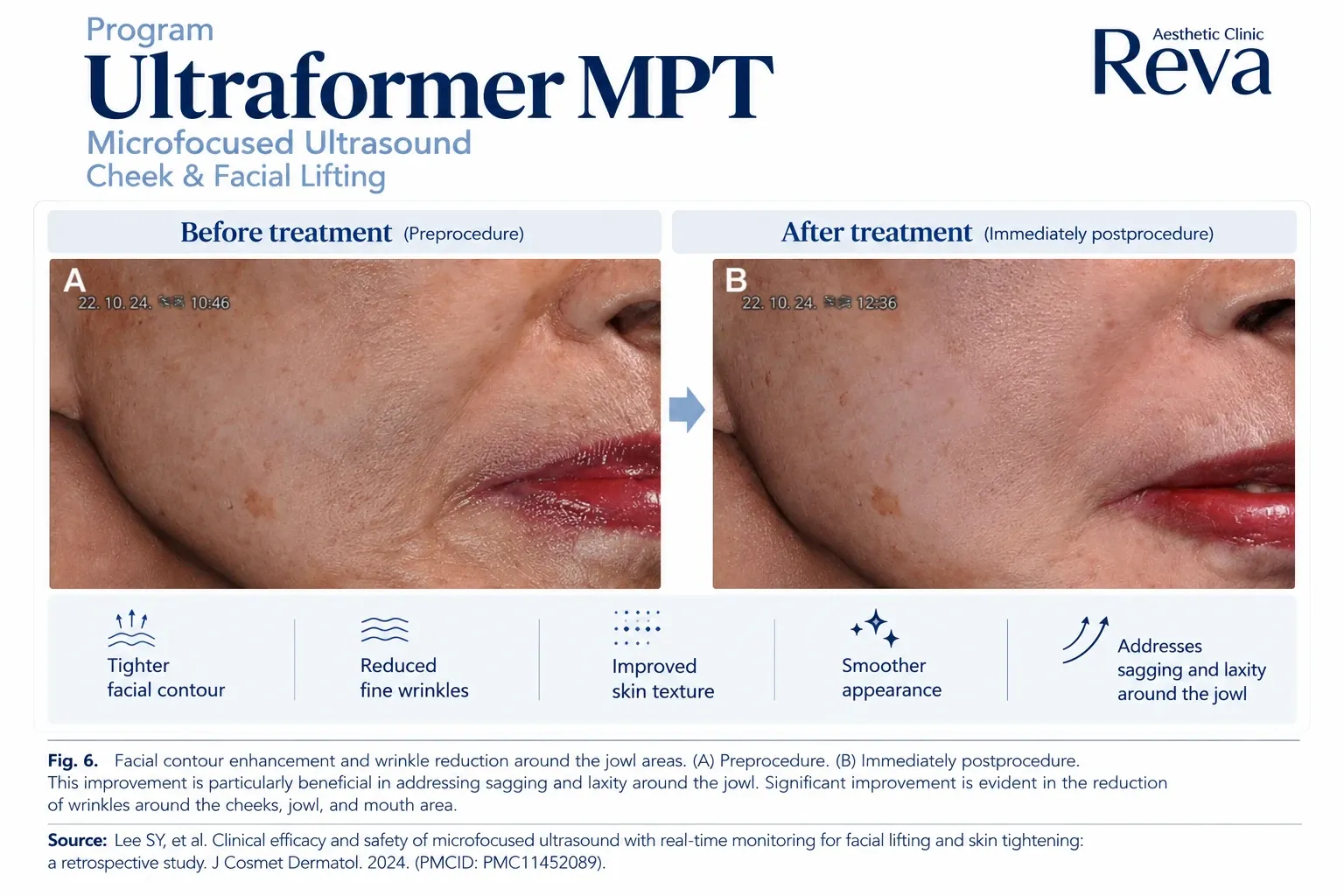 รีวิว Ultraformer mpt รักษาร่องข้างแก้ม