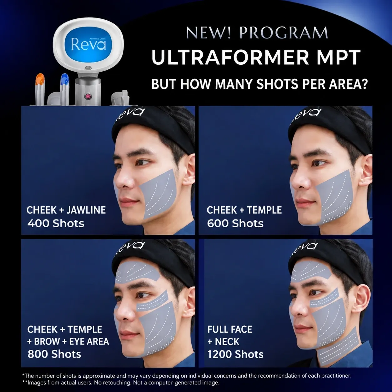Chart of suggested shot counts by face and neck area; a doctor determines the exact number