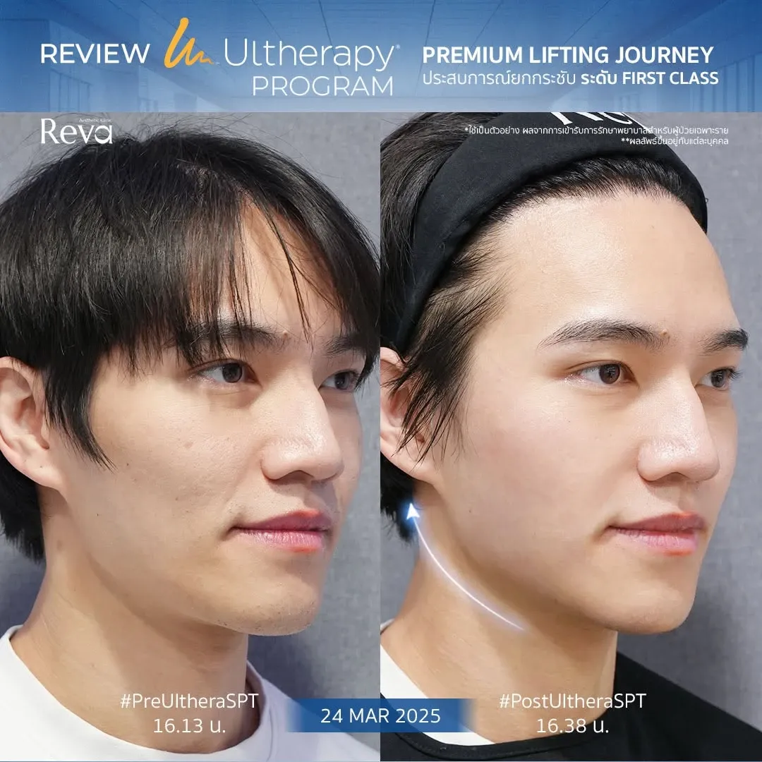 ภาพเปรียบเทียบก่อนและหลังทำ Program Ulthera SPT ที่ Reva Clinic มุมเฉียง แสดงการเปลี่ยนแปลงบริเวณ
