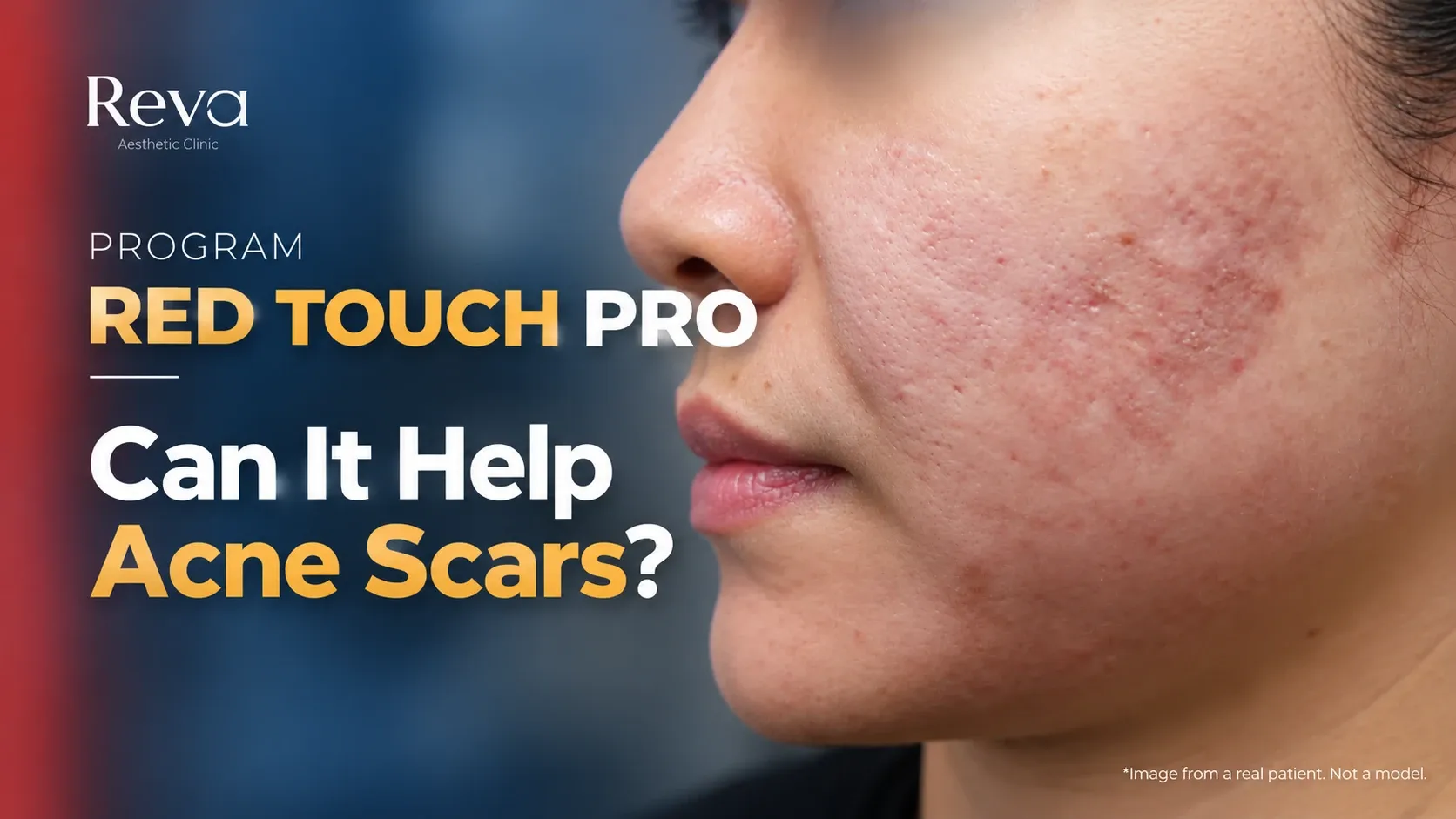 RedTouch Pro Improve Acne Scars? 
