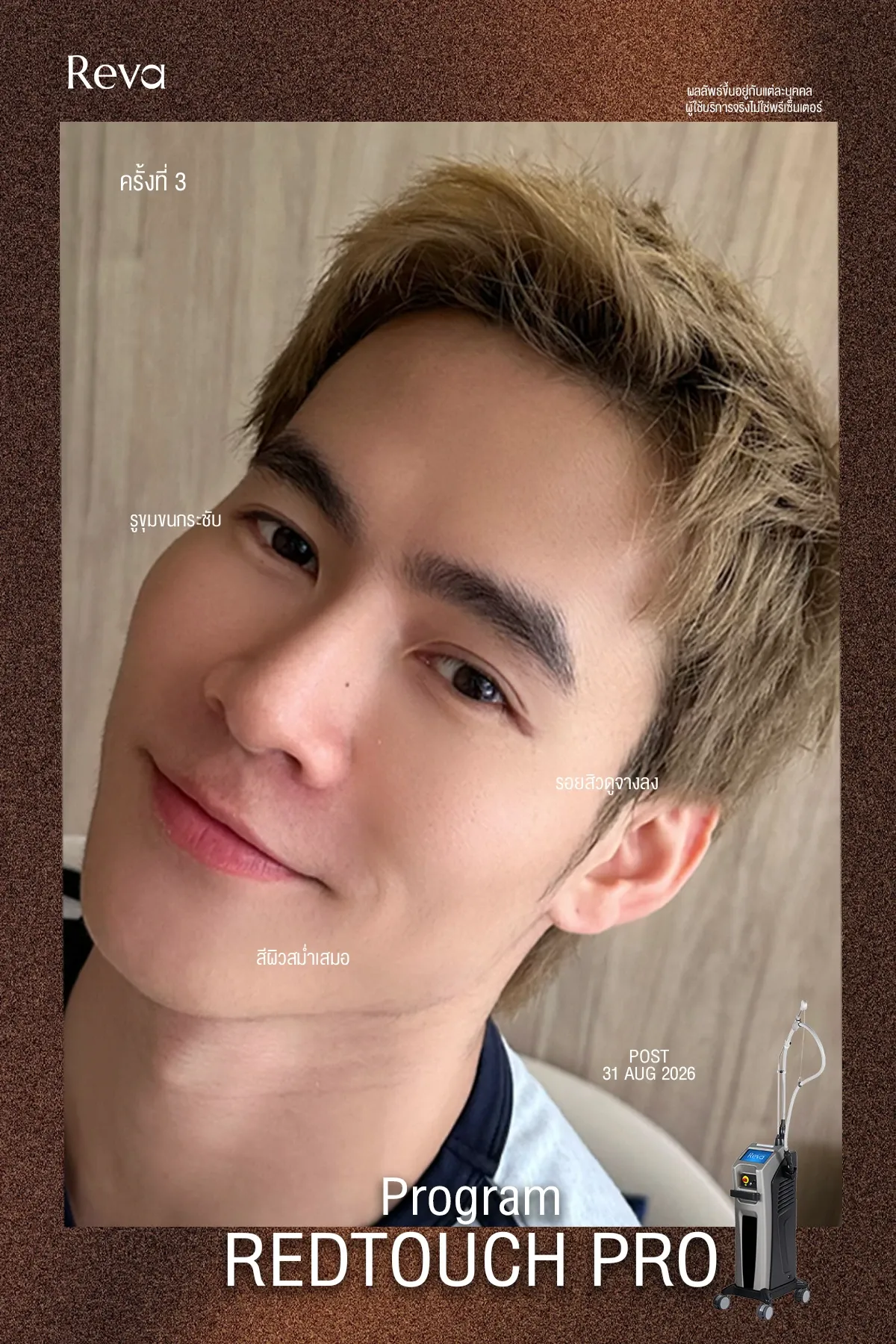 รีวิวทำ red touch หลัง 3 เดือน